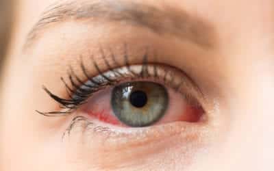 Six Common Eye Infections: What to Do